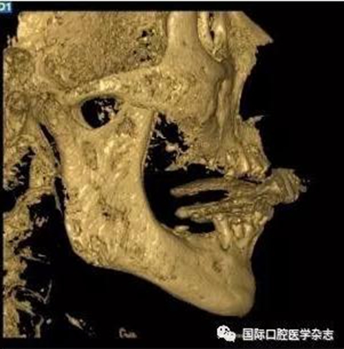 张清彬谈张口受限 
