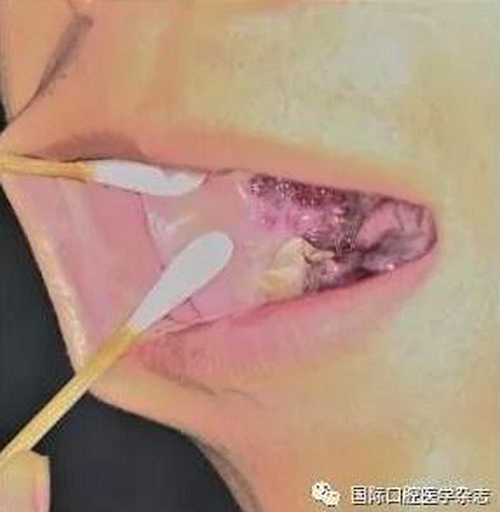 张清彬谈张口受限 