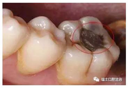 这个很错误,龋齿是细菌在作祟.细菌破坏牙冠后会继续向里破坏牙根.