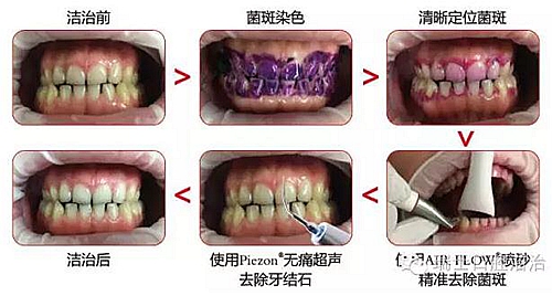 儿童龋齿情况逐年上升,龋齿真就防不住 科贸嘉友收录