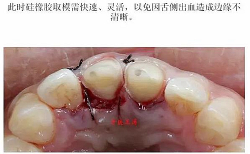 前牙外伤冠延长+全瓷冠修复