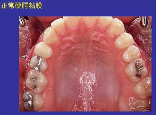 正常口腔黏膜及常见病损图