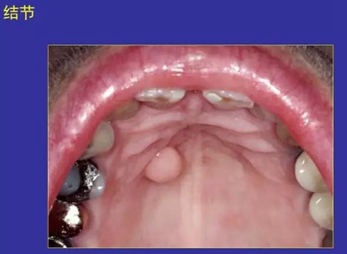 正常口腔黏膜及常见病损图