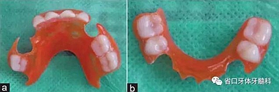 【牙医学堂】间隙保持器的介绍  