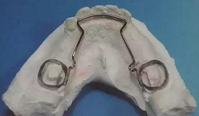 【牙医干货】各种间隙保持器赏析