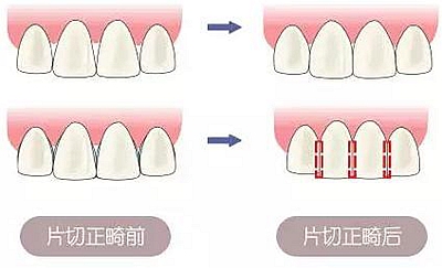 医生方案里的邻面去釉，究竟是什么？