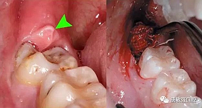 为何一颗小小的智齿会危及到自己的生命? 科贸嘉友收录