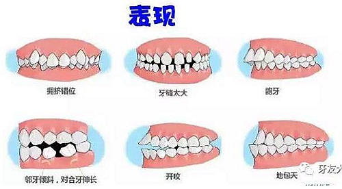 “发现即矫正”12岁前必须处理的20种儿童牙颌畸形 