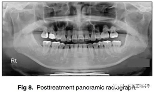 通入上颌窦上颌后牙区间隙的关闭探索