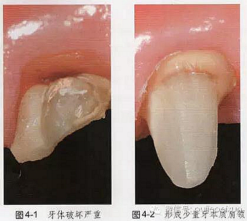 预备要求进行牙体初步预备,在这个过程中,需要注意尽量保存牙本质肩领