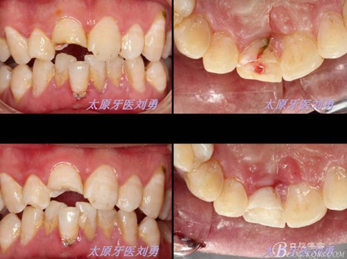 刘勇：断牙再粘结两例病例 