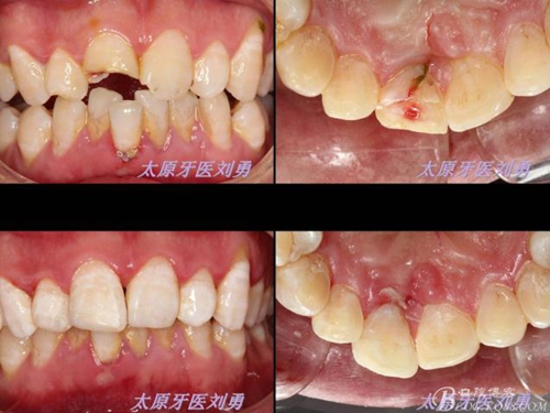 刘勇：断牙再粘结两例病例 