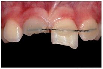 牙体大面积缺损：根管治疗后行纤维桩—树脂修复   