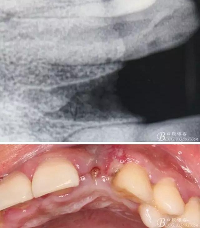 一例上前牙种植失败病例的补救