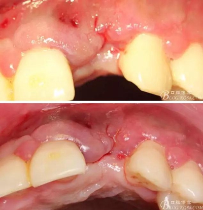一例上前牙种植失败病例的补救