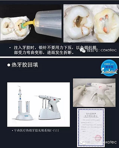 【现代根管治疗】之热牙胶充填技术