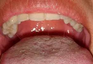 艾滋病早期重要症状：口腔的各种表现  