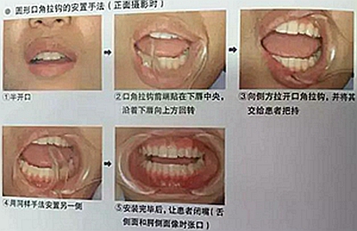 口腔摄影方法与技巧