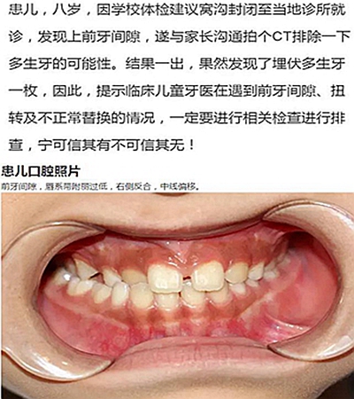 多生牙的拔除总原则：早发现，早处理！