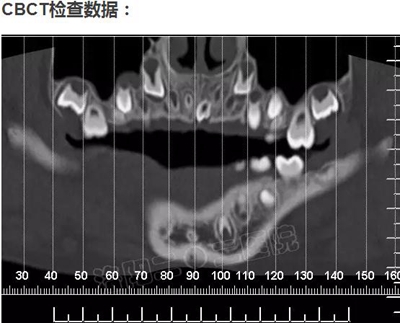 多生牙的拔除总原则：早发现，早处理！