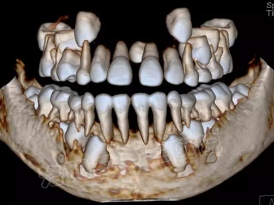 多生牙的拔除总原则：早发现，早处理！