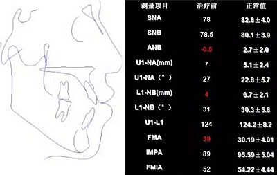 种植钉多维运用矫正高角反颌及开颌—对罗晨医生专访及病例展示（上）