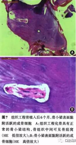 组织工程骨修复上颌骨缺损及牙种植一例 