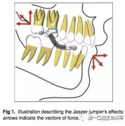 正畸文献阅读--用Jasper跳跃矫治器治疗II类患者的长期稳定性