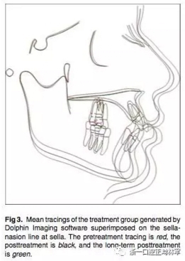 正畸文献阅读--用Jasper跳跃矫治器治疗II类患者的长期稳定性