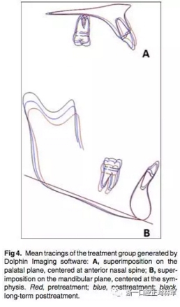 正畸文献阅读--用Jasper跳跃矫治器治疗II类患者的长期稳定性