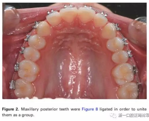 正畸文献阅读-两种不同矫治力下上颌后牙段远移的生化与临床比较