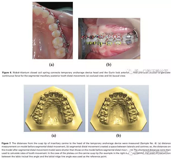 正畸文献阅读-两种不同矫治力下上颌后牙段远移的生化与临床比较