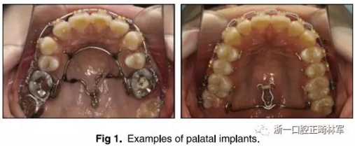 正畸文献阅读--上颌支抗初次植入失败后二次植入稳定性的研究
