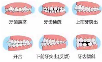 关于牙齿矫正，你想知道的都在这！