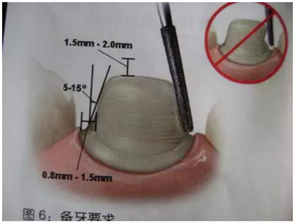 医生，我的烤瓷牙上有个黑线怎么回事？