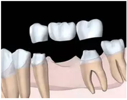 固定假牙（烤瓷牙）的致命缺点
