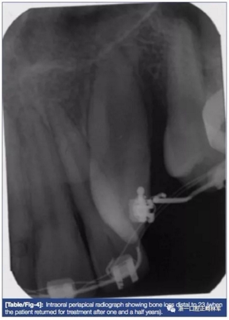 文献优秀正畸病例赏析--牙周加速成骨正畸（PAOO）辅助的腭侧埋伏尖牙牵引矫治及5年跟踪随访