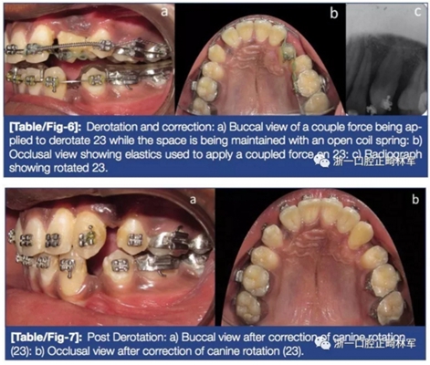 文献优秀正畸病例赏析--牙周加速成骨正畸（PAOO）辅助的腭侧埋伏尖牙牵引矫治及5年跟踪随访
