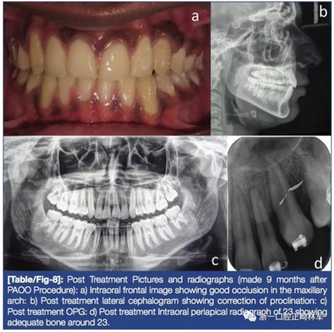 文献优秀正畸病例赏析--牙周加速成骨正畸（PAOO）辅助的腭侧埋伏尖牙牵引矫治及5年跟踪随访
