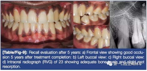 文献优秀正畸病例赏析--牙周加速成骨正畸（PAOO）辅助的腭侧埋伏尖牙牵引矫治及5年跟踪随访