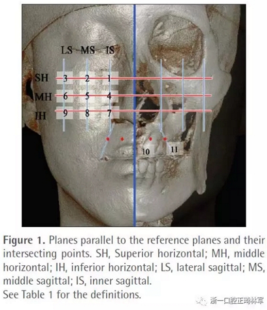 正畸文献阅读--无症状单侧唇腭裂患者面中部不对称的三维分析