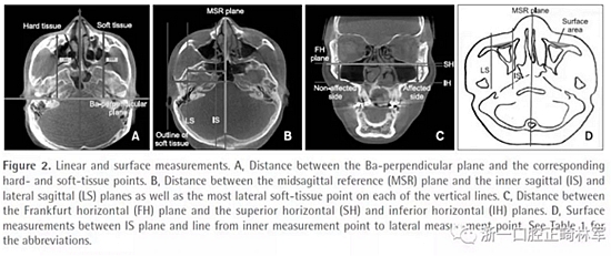 正畸文献阅读--无症状单侧唇腭裂患者面中部不对称的三维分析
