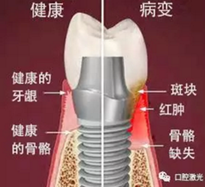 种植体周围炎的激光疗法