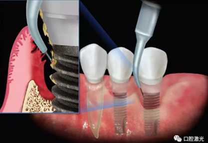种植体周围炎的激光疗法