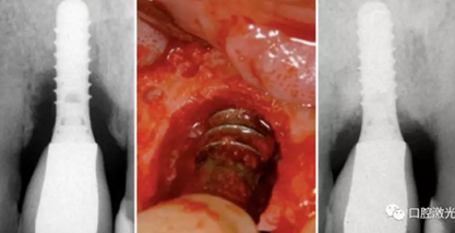 种植体周围炎的激光疗法