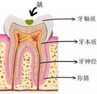 当心“腹黑”龋齿，牙齿有个小洞也要补！