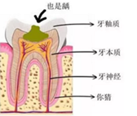 当心“腹黑”龋齿，牙齿有个小洞也要补！