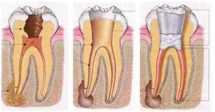 根管治疗时4种残髓处理方法1