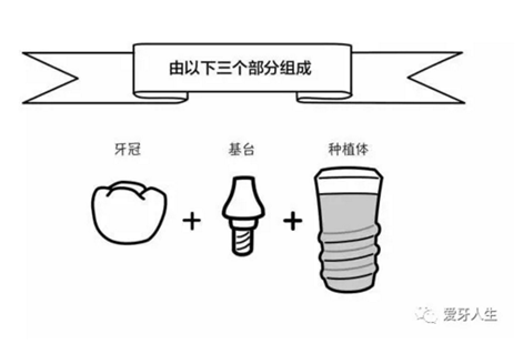 如何选择种植牙，给《患者》推荐这篇文章就足矣