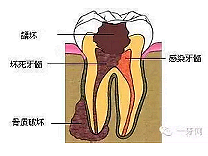 详解牙疼的原因分几种？